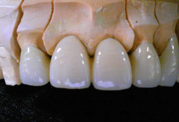 レジンの詰め物（レジン充填）