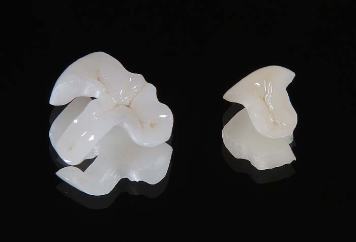 セラミックの詰め物・被せ物