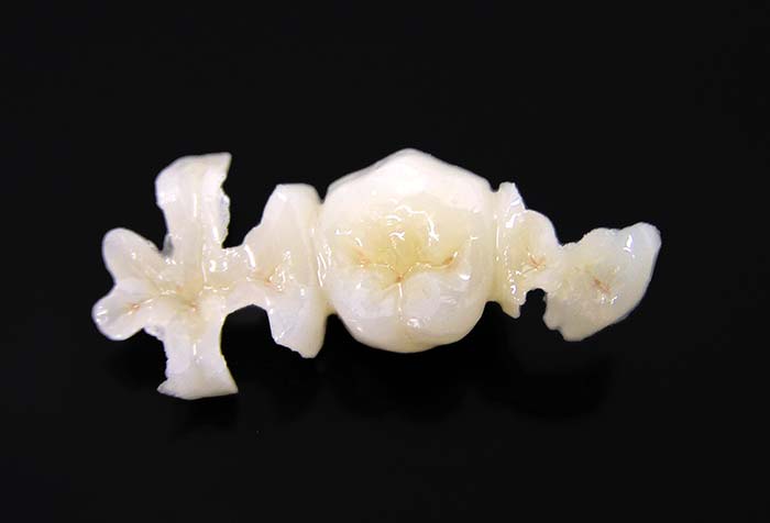 ハイブリッドの詰め物・被せ物