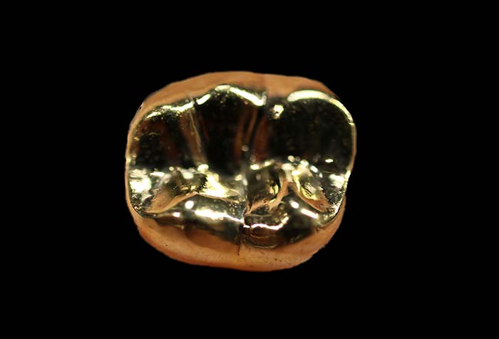 ゴールドの詰め物・被せ物