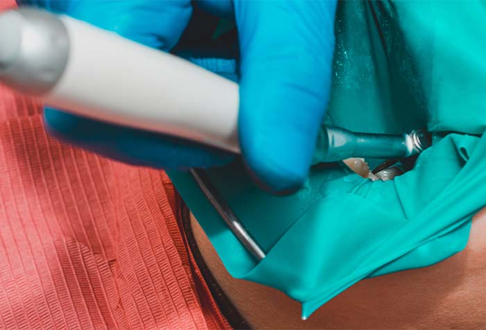 歯髄まで歯を削る