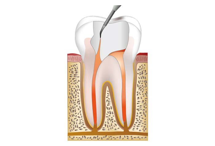 薬剤を詰めて密封する