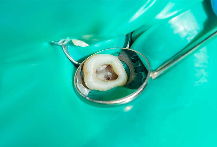 「ラバーダム」による清潔で安全性の高い治療