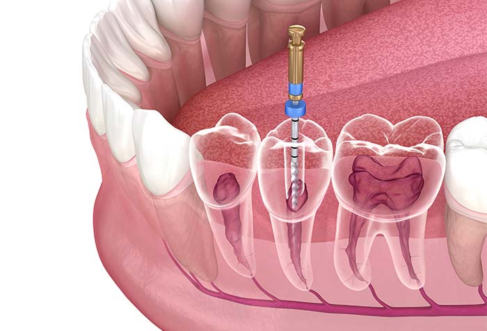 根管治療はどのような治療？