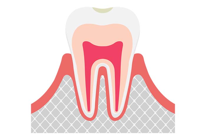 初期のむし歯