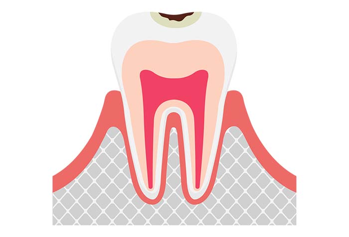 エナメル質のむし歯