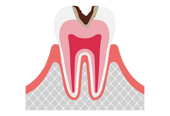象牙質まで進行したむし歯