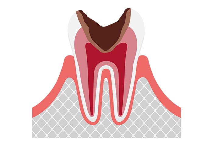 神経まで進行したむし歯