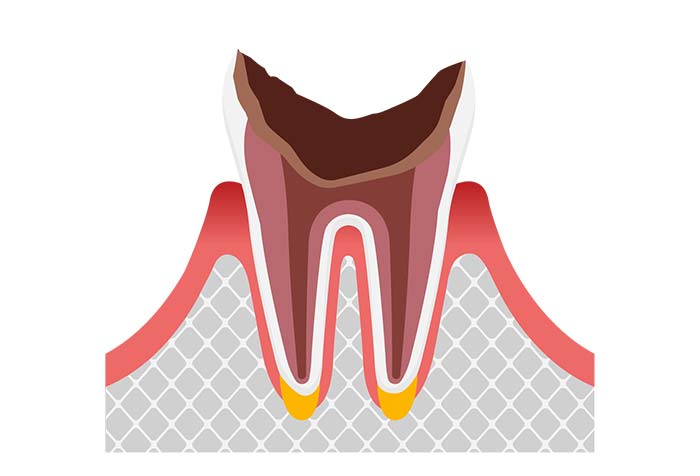 歯根だけ残ったむし歯