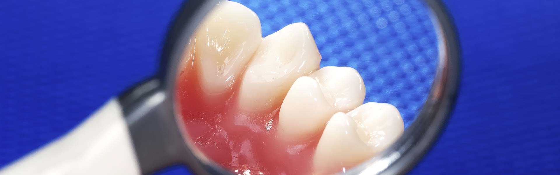 むし歯治療