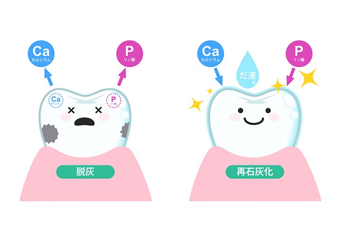 むし歯の原因は？