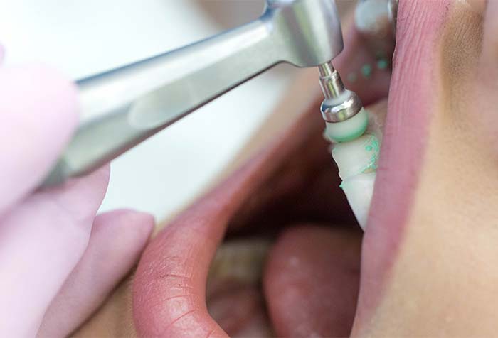 プロのクリーニング「PMTC」