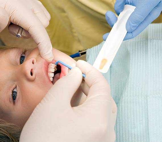 お子様から大人の方まで「フッ素塗布」を