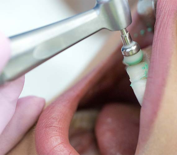 本来の自然な歯の白さを取り戻す「PMTC」