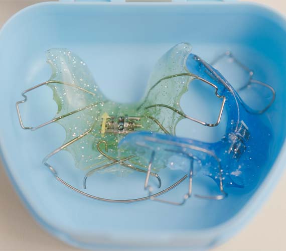 将来の歯並びを守る「拡大床」による小児矯正