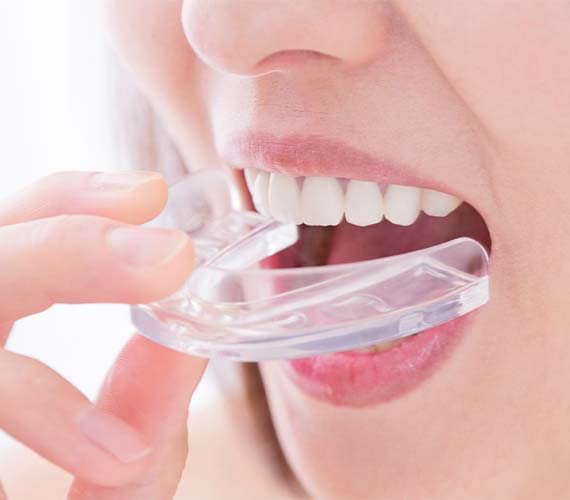 マウスピース製作